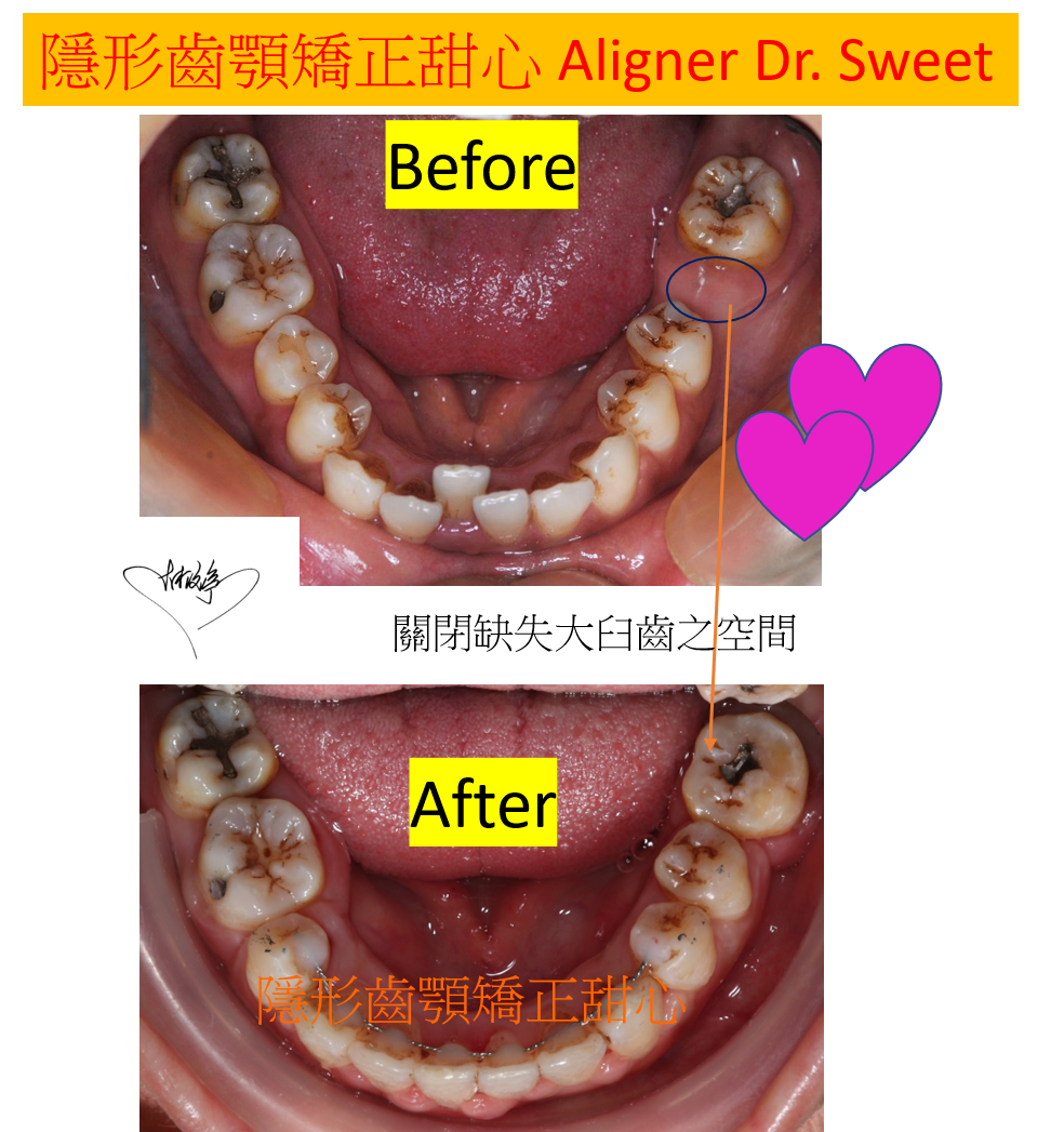 關閉大顆大臼齒空間案例分享 千代牙科 高雄隱適美