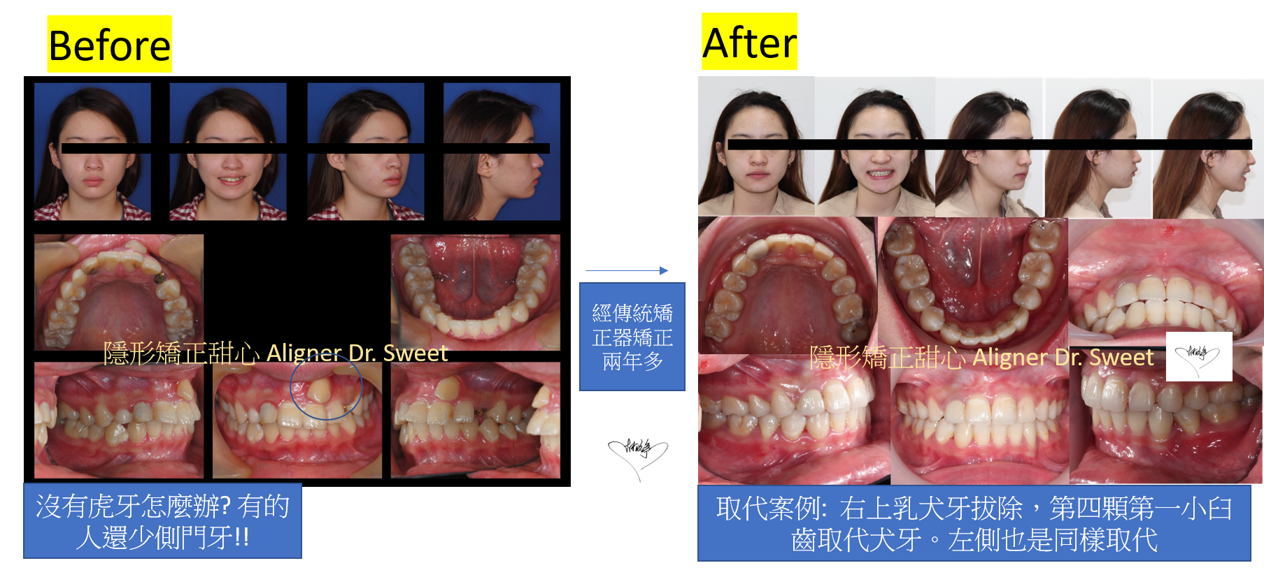 今天分享取代案例 小臼齒取代缺失犬牙或者前牙缺失案例 千代牙科 高雄隱適美